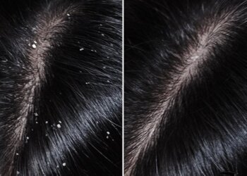 Ketombe? Ini Cara Keramas Agar Bebas Ketombe!