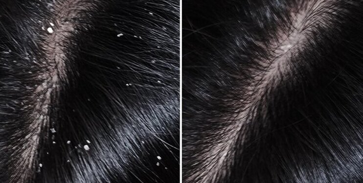 Ketombe? Ini Cara Keramas Agar Bebas Ketombe! - Featured