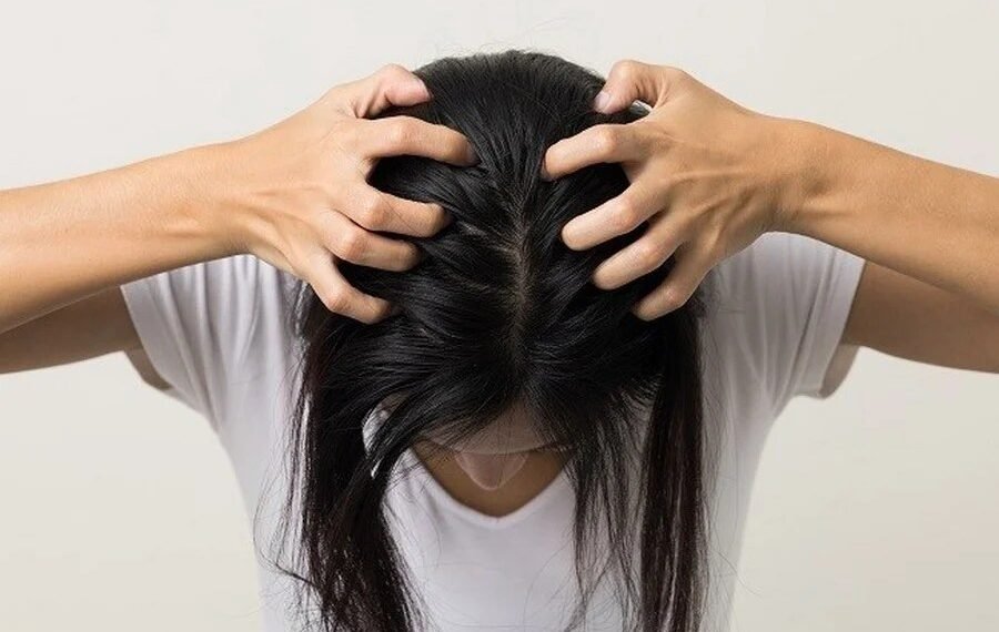 Solusi Alami Untuk Mengatasi Kutu Rambut dan Telurnya