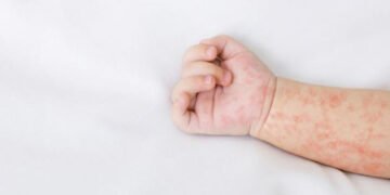 Sulawesi Selatan Tetapkan KLB Campak: Ratusan Anak Terinfeksi, Apa Langkah Dinkes?